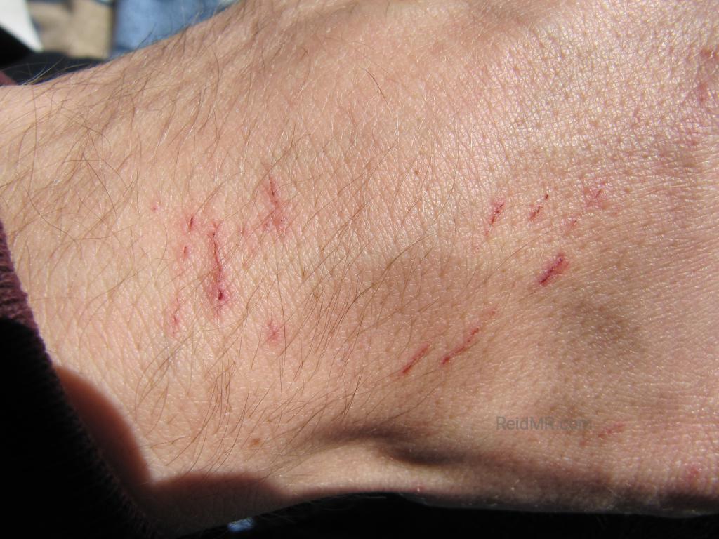 Scratches on my hands from thorns.