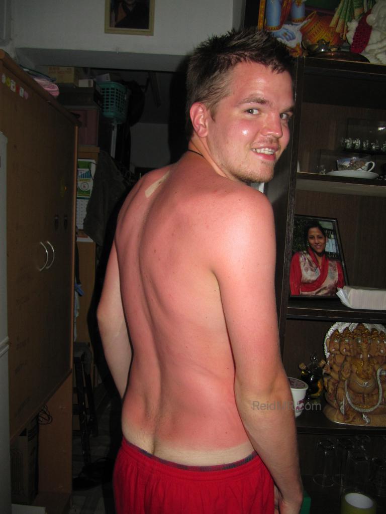 My red sunburned back, with three of my four cheeks showing